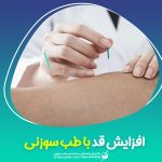 افزایش قد با طب سوزنی