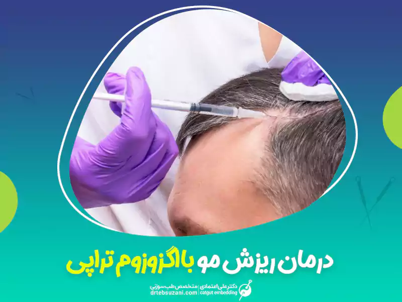 درمان ریزش مو با اگزوزوم تراپی